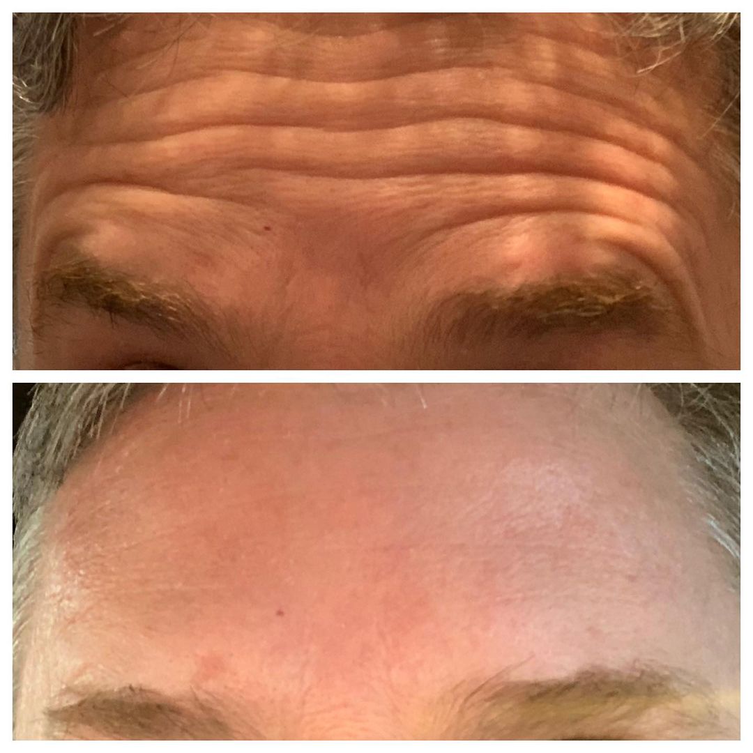 Bella Derma Laser and Med Spa botox for men