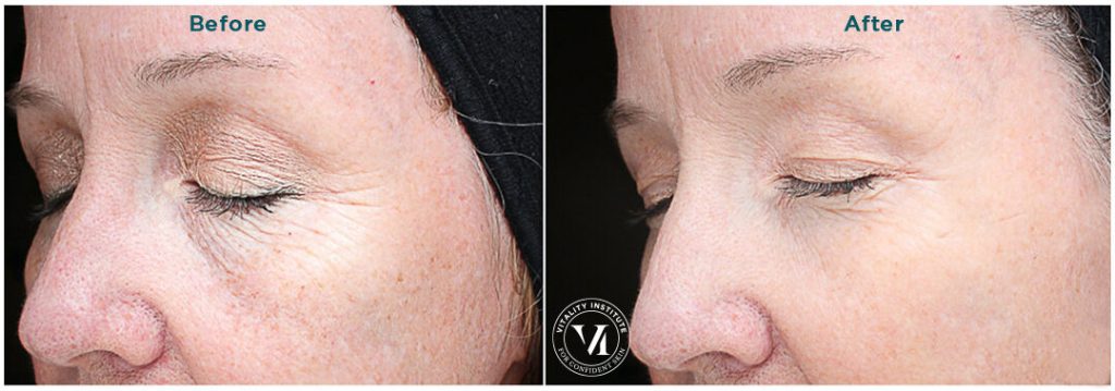 Bella Derma Laser VI Peel