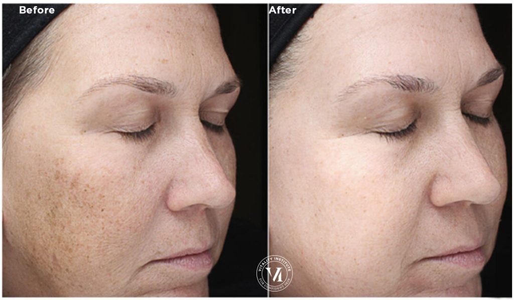 Bella Derma Laser VI Peel