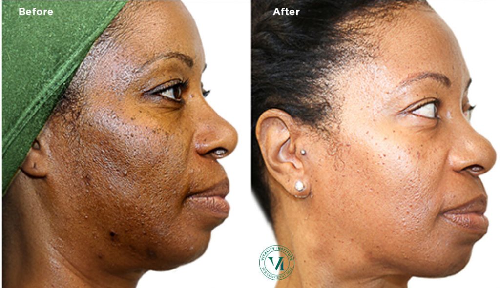 Bella Derma Laser VI Peel