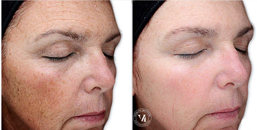Bella Derma Laser VI Peel