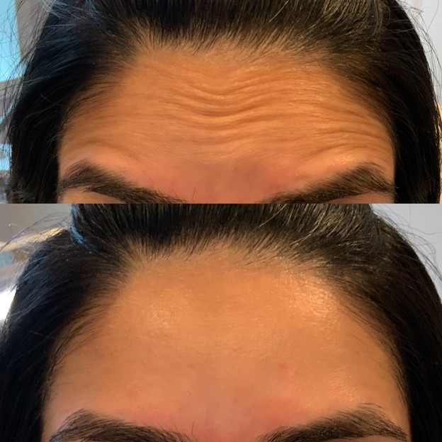 Bella Derma Laser & Med Spa Eagleville PA Injectables Blog