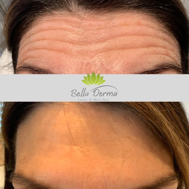 Bella Derma Laser & Med Spa Eagleville PA Injectables Blog