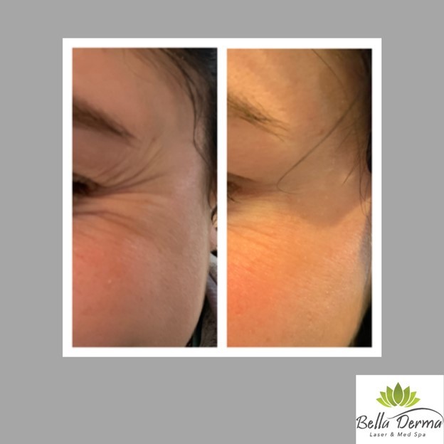 Bella Derma Laser & Med Spa Eagleville PA Injectables Blog