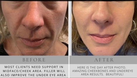 Bella Derma Laser & Med Spa Dermal Fillers Blog Pic 2