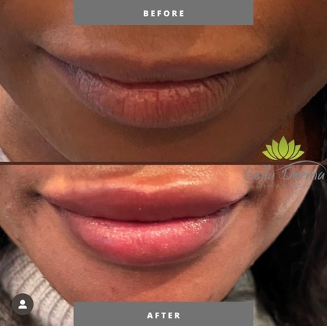 Bella Derma Laser & Med Spa Dermal Fillers Blog Pic 3