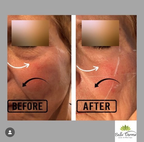 Bella Derma Laser & Med Spa Dermal Fillers Blog Pic 4